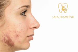 إزالة آثار الحروق من الوجه بسرعة: 0546444116