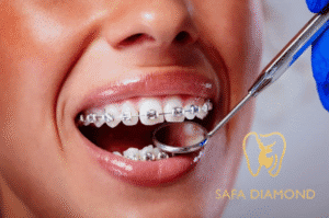 عروض على تقويم الأسنان جدة: 0546444116