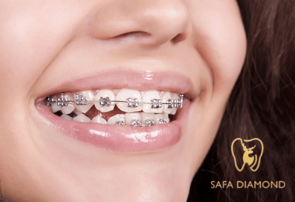 عروض على تقويم الأسنان جدة: 0546444116