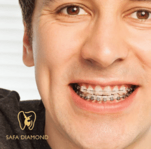 عروض على تقويم الأسنان جدة: 0546444116