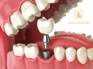 أفضل عيادات الأسنان في جدة لزراعة الأسنان بأسعار مناسبة: 0546444116