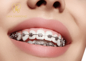 فين أركب تقويم أسنان بجودة عالية في جدة: 0546444116