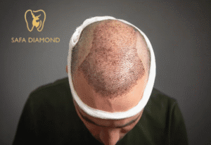 زراعة الشعر في جدة بكم: 0546444116