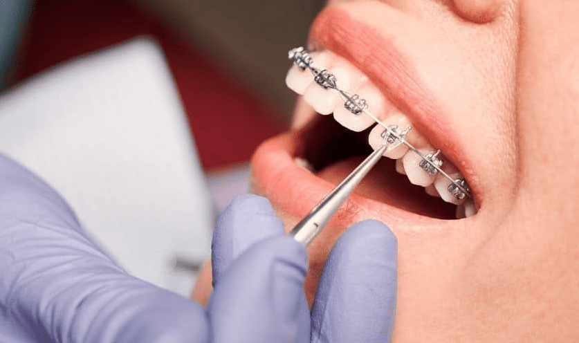 عيادات تقويم اسنان بجدة رخيصة: 0546444116