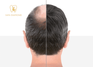 عيادات صفا الماسي زراعة الشعر: 0546444116
