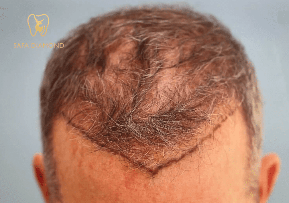 عيادات صفا الماسي زراعة الشعر: 0546444116