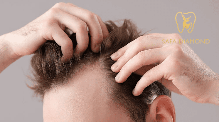 تجربتي مع زراعة الشعر في جدة: 0546444116