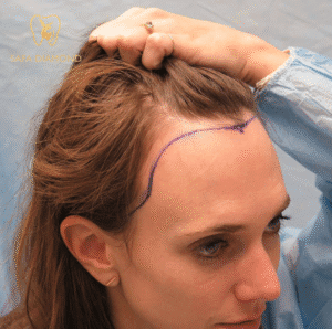 تجربتي مع زراعة الشعر في جدة: 0546444116