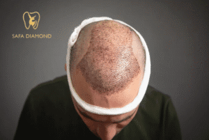 عروض زراعة الشعر في جدة: 0546444116