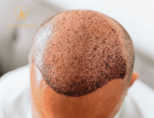 عروض زراعة الشعر في جدة: 0546444116
