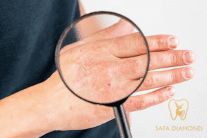 افضل دكتور جلدية في جدة لعلاج الأكزيما: 0546444116