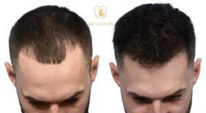 زراعة شعر بجدة: 0546444116