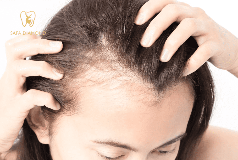 زراعة شعر بجدة: 0546444116