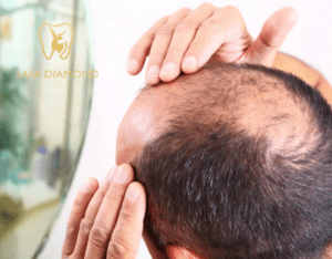 علاج الصلع الأمامي عند الرجال: 0546444116