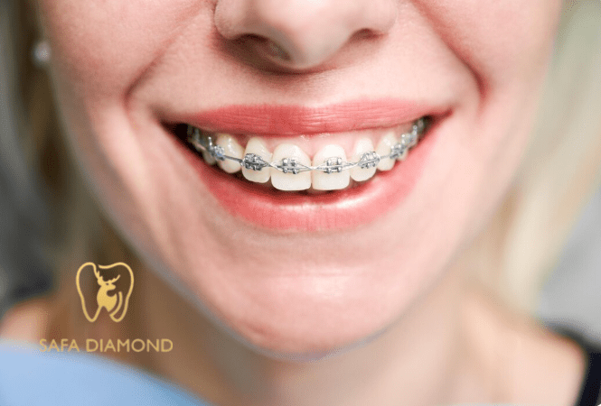 أفضل عيادة أسنان في جدة للتقويم: 0546444116
